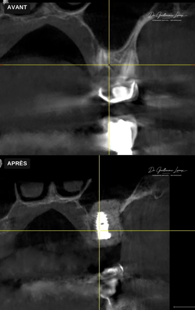 Coupe radiographique CBCT d'un implant avec sinus lift, avant et après