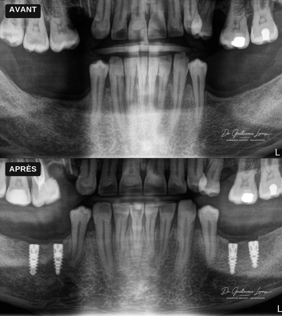 Radiographie panoramique de quatre implants dentaires postérieurs, avant et après