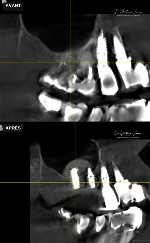 Radiographie panoramique d'implants dentaires avec sinus lift, avant et après