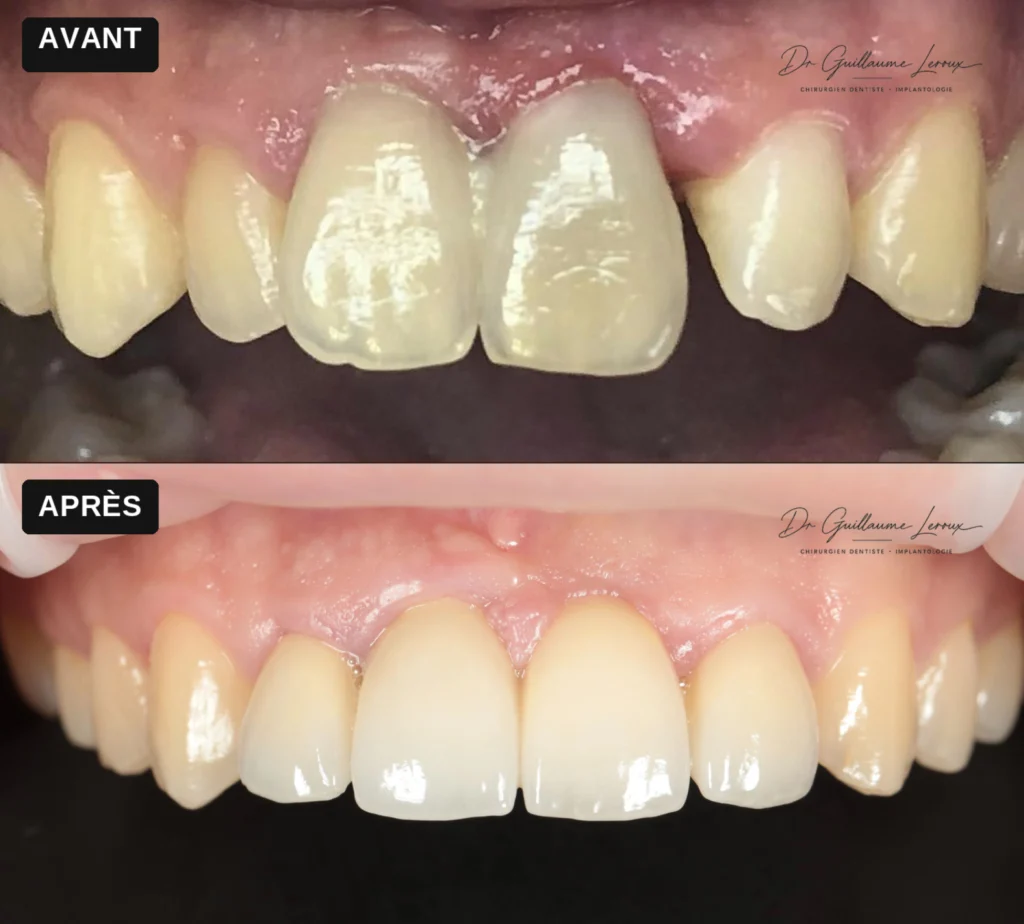 Restauration d'une dent antérieure, avant et après traitement