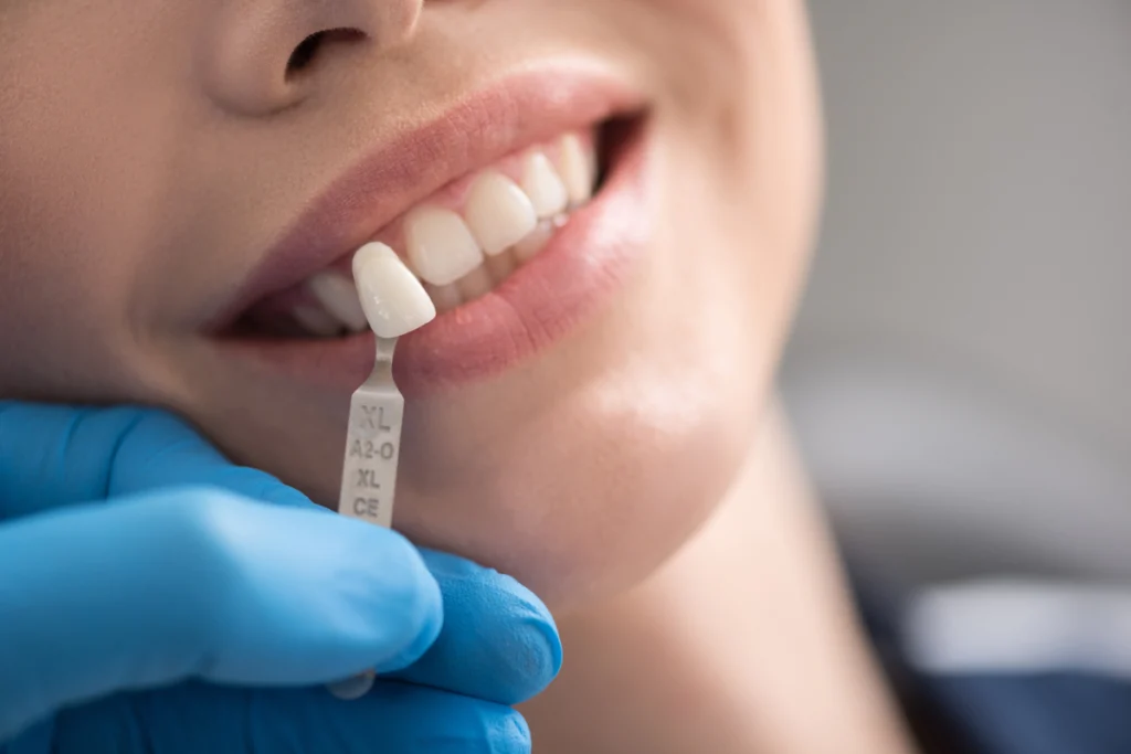 Choix de la teinte des dents avec un teintier