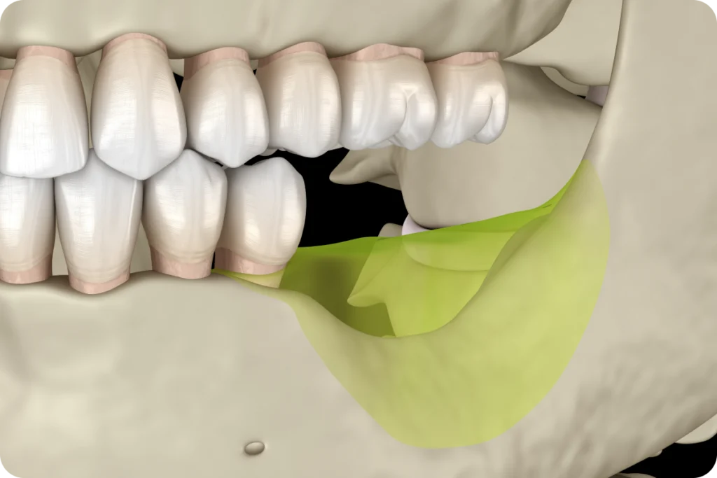 Illustration 3D d'une greffe osseuse dentaire au niveau d'une molaire