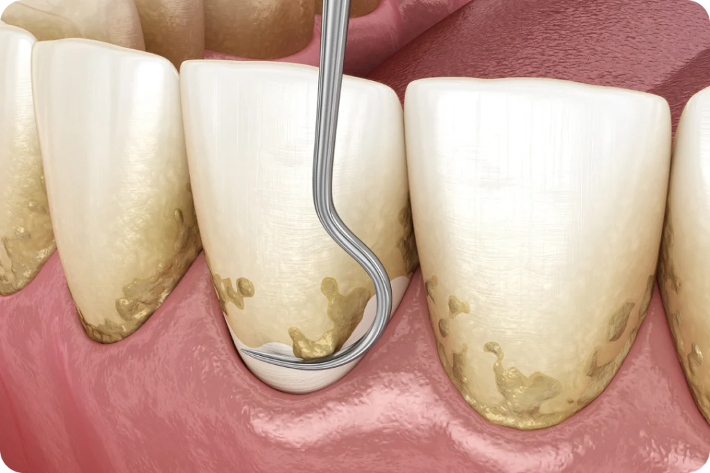 Dents présentant du tartre avant détartrage