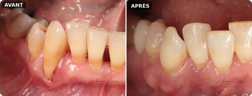 Sourire avant et après une réhabilitation dentaire esthétique