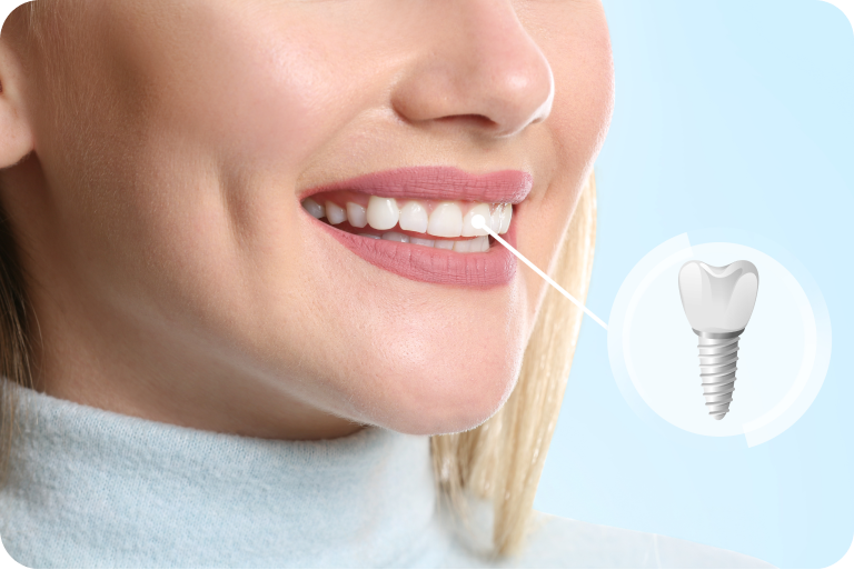 implants dentaires aspremont Femme souriante et illustration d’un implant avec sa couronne