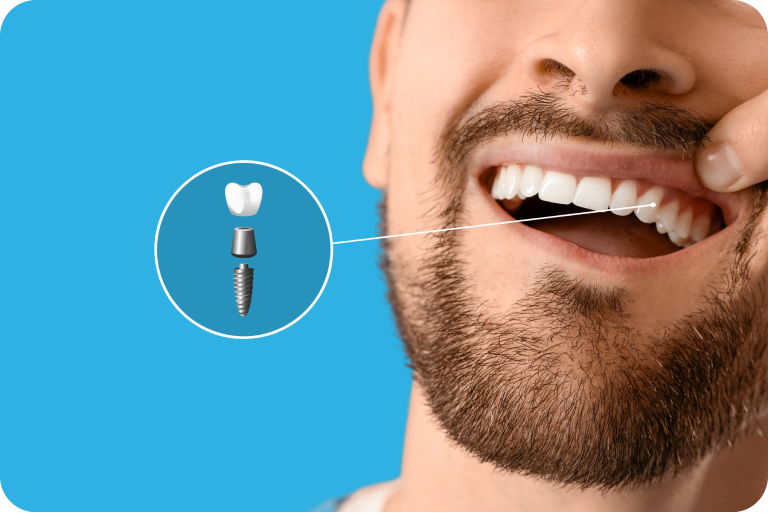 Homme souriant, illustration d’un implant dentaire en médaillon